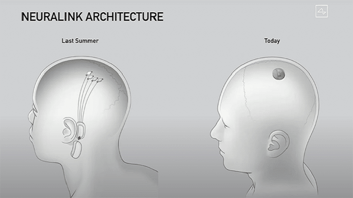 (Os implantes no cérebro, nos olhos e na espinal medula podem tornar-se padrão num futuro próximo, graças ao rápido progresso da Neuralink)